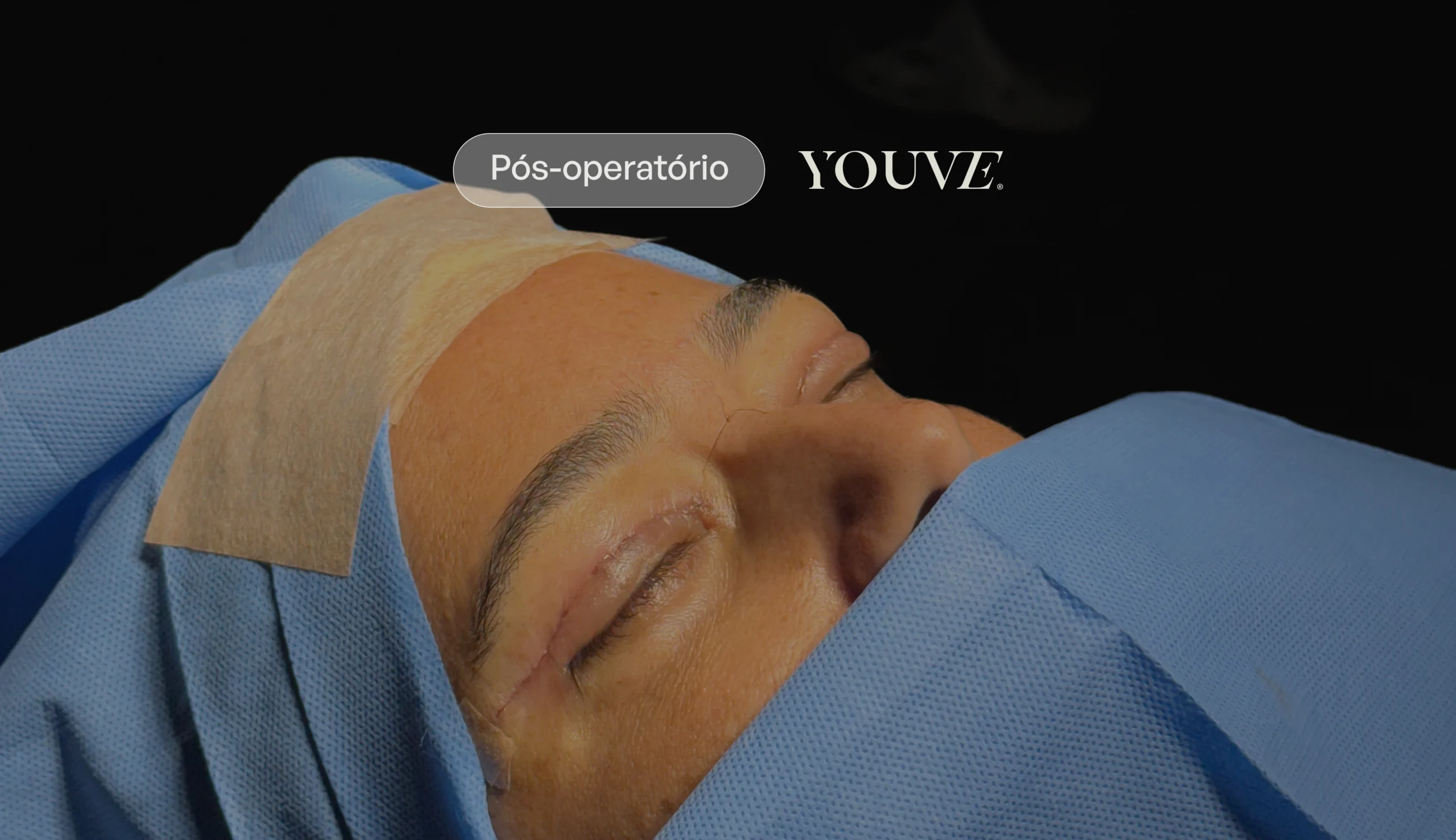 Cicatriz da blefaroplastia: o que realmente fica visível no seu olhar?