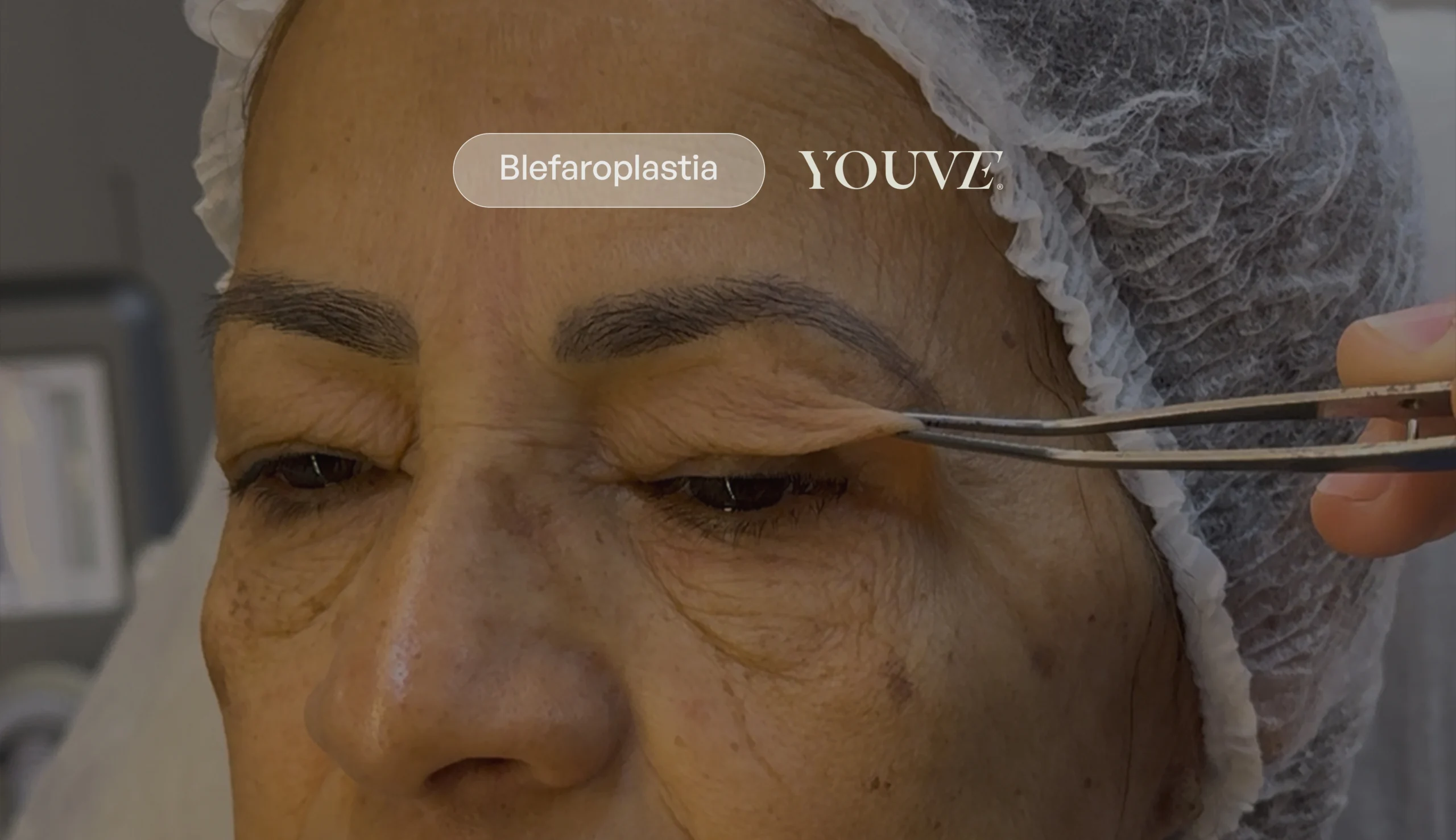 Quanto custa blefaroplastia? Fatores que definem o valor do seu novo olhar