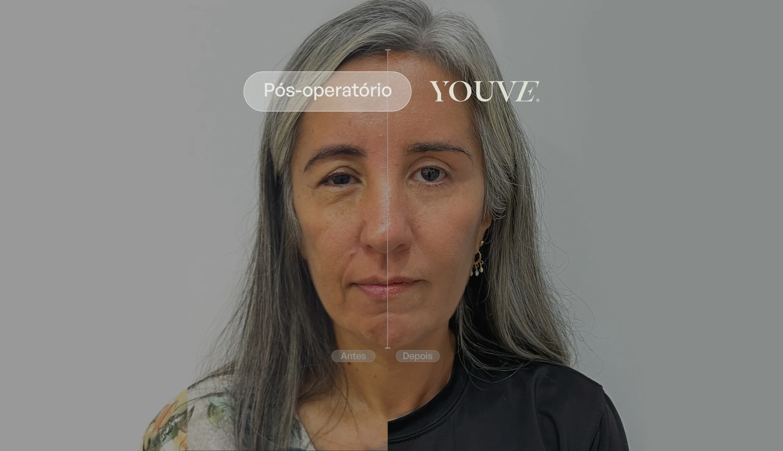 Antes e depois da blefaroplastia: resultados reais com Visagismo do Olhar