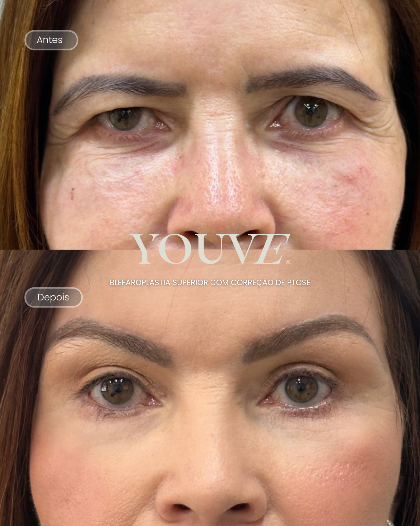 Antes e depois blefaroplastia