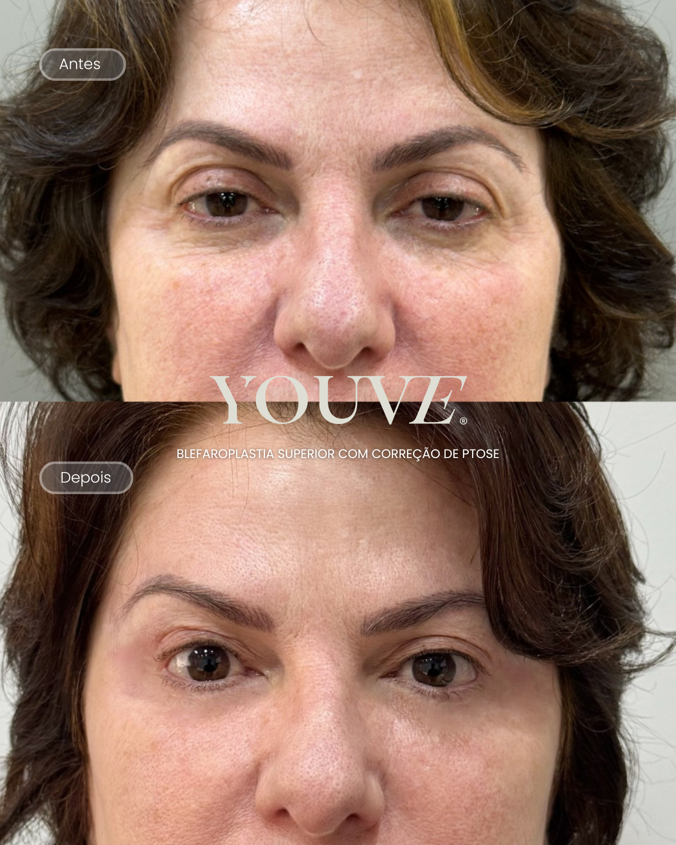 Antes e depois blefaroplastia