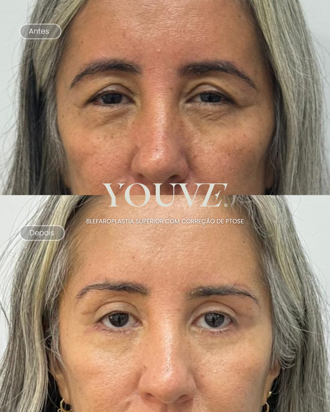 Antes e depois blefaroplastia