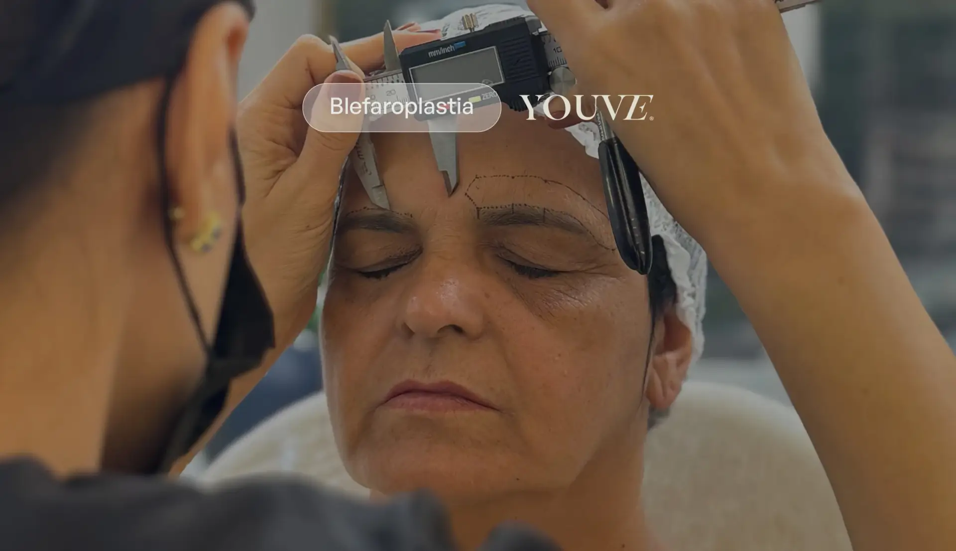 Blefaroplastia a laser: a verdade sobre essa tendência (e quando realmente funciona)